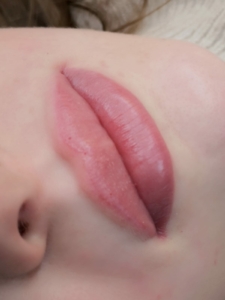Dermatopigmentatie baby lips 5
